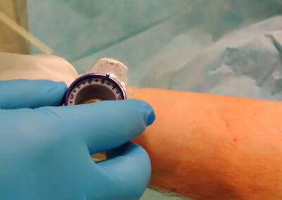 Protocolo de descompresión radial