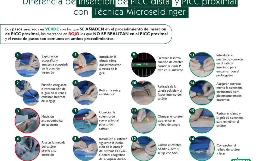 Diferencia de inserción de PICC distal y PICC proximal con Técnica Microseldinger