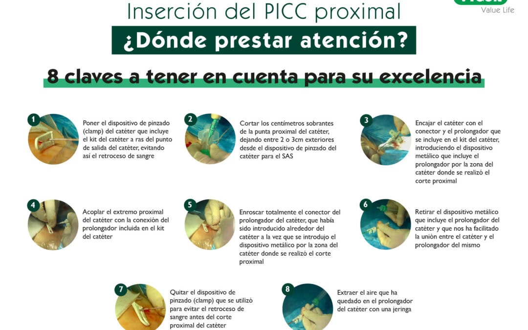 Catéter de corte proximal: ¿Dónde prestar atención?