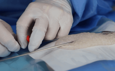 Optimización del acceso vascular en oncología: el papel clave de la tunelización