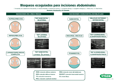 Bloqueos ecoguiados para incisiones abdominales