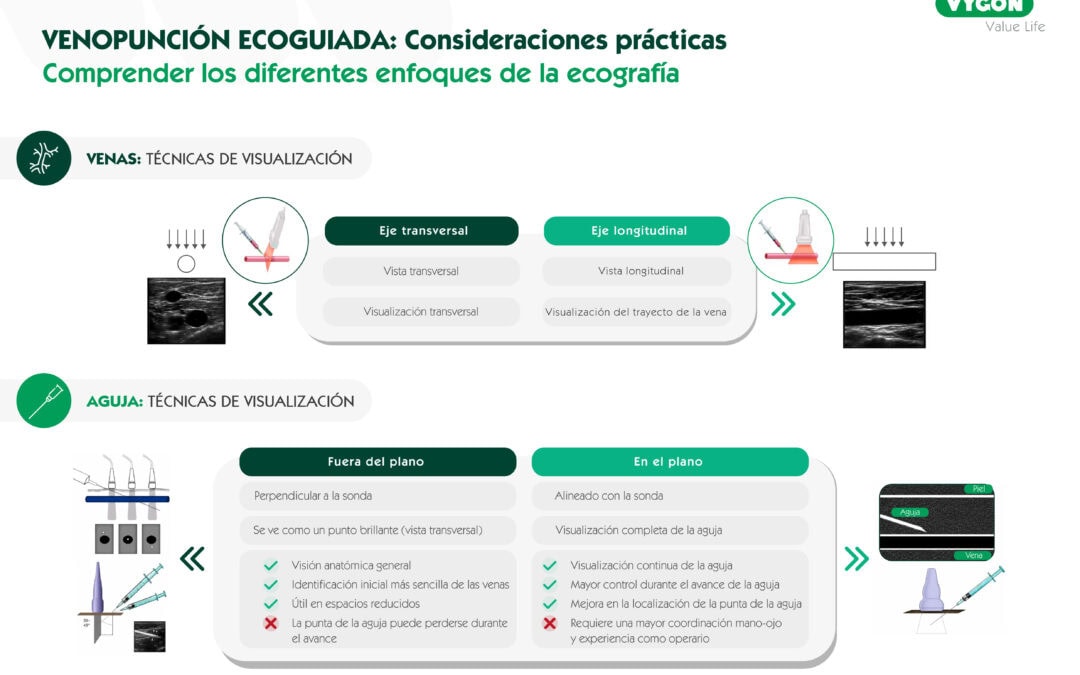 Venopunción ecoguiada: Consideraciones prácticas. Comprender los diferentes enfoques de la ecografía