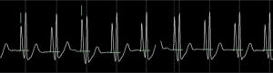 Comment localiser l'extrémité d'un PICC - ECG(2)