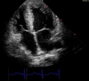 Comment localiser l'extrémité d'un PICC - Echocardiographie