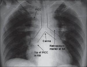 Comment localiser l'extrémité d'un PICC - Radiographie