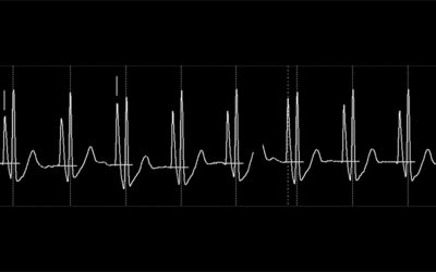 How to locate the tip of a PICC