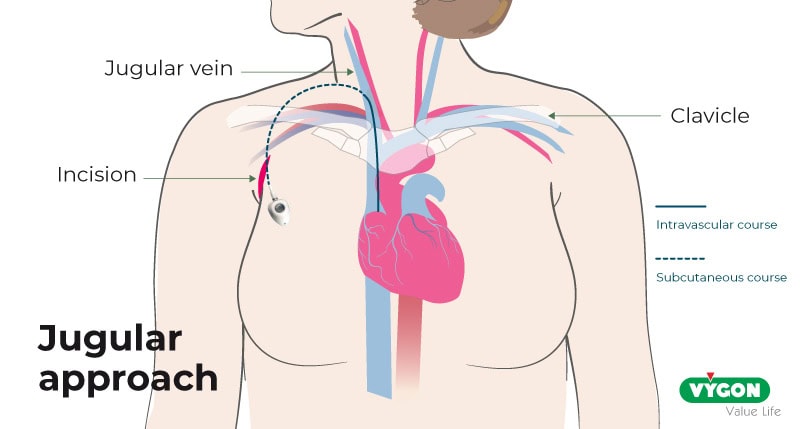 Jugular_approach_for_port_placement