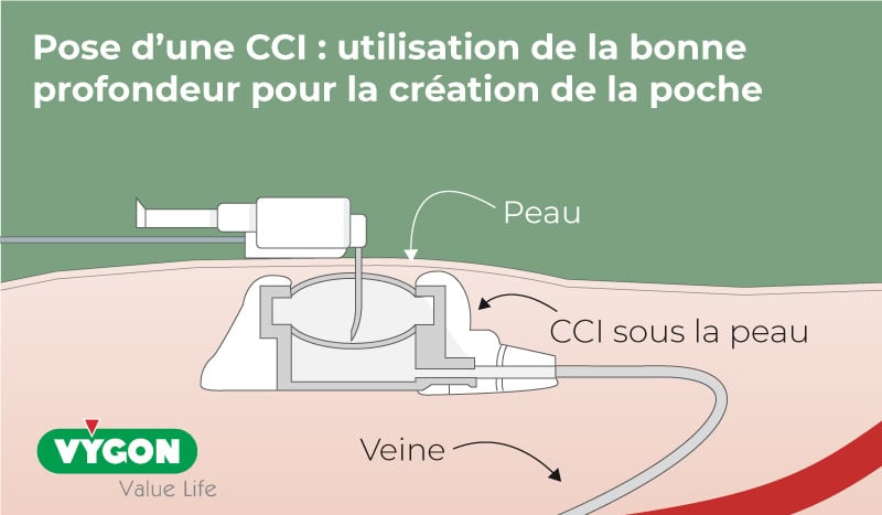 Pose-CCI-utilisation-bonne-profondeur-création-de-poche