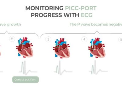 Monitoring PICC Port progress with ECG