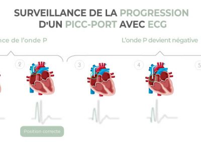 Surveillance de la progression d’un PICC-port avec l’ECG