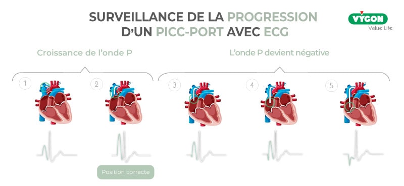 Surveillance-progression-PICC-port-ECG