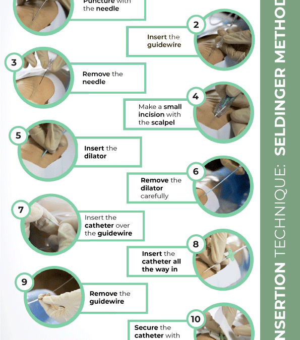 Insertion technique: Seldinger method