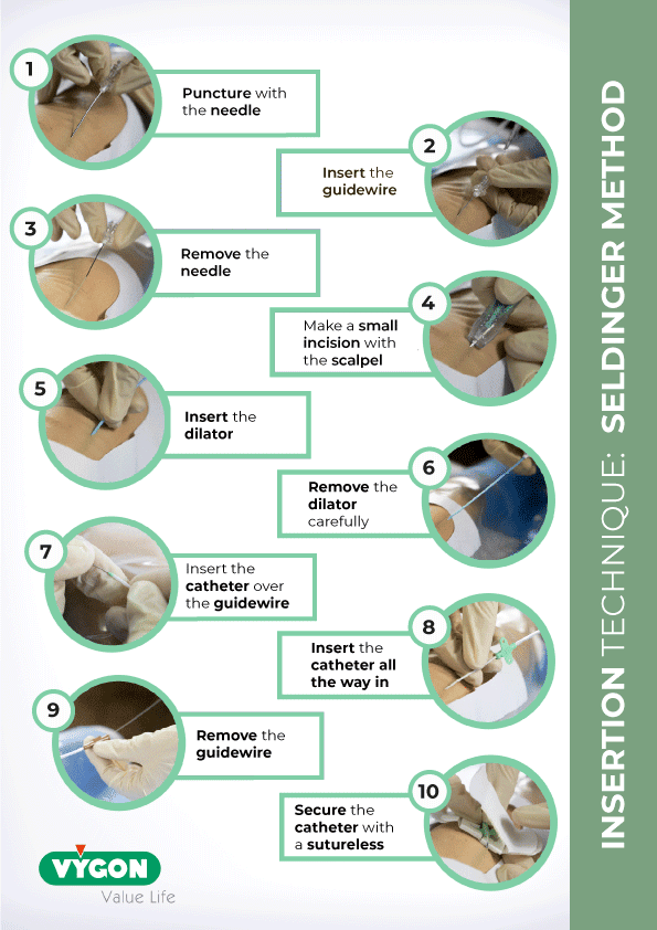 Catheter-Insertion-Seldinger-technique