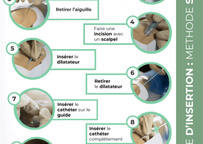 Technique d’insertion : Méthode Seldinger