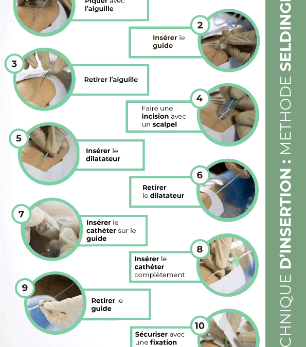 Technique d’insertion : Méthode Seldinger