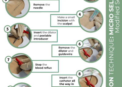 Insertion technique: micro seldinger modified seldinger