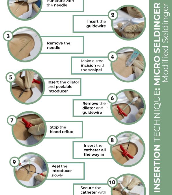 Insertion technique: micro seldinger modified seldinger