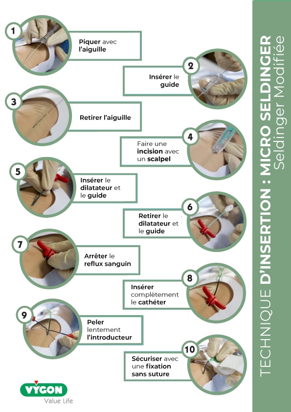 Technique-Micro-Seldinger-Insertion-Midline