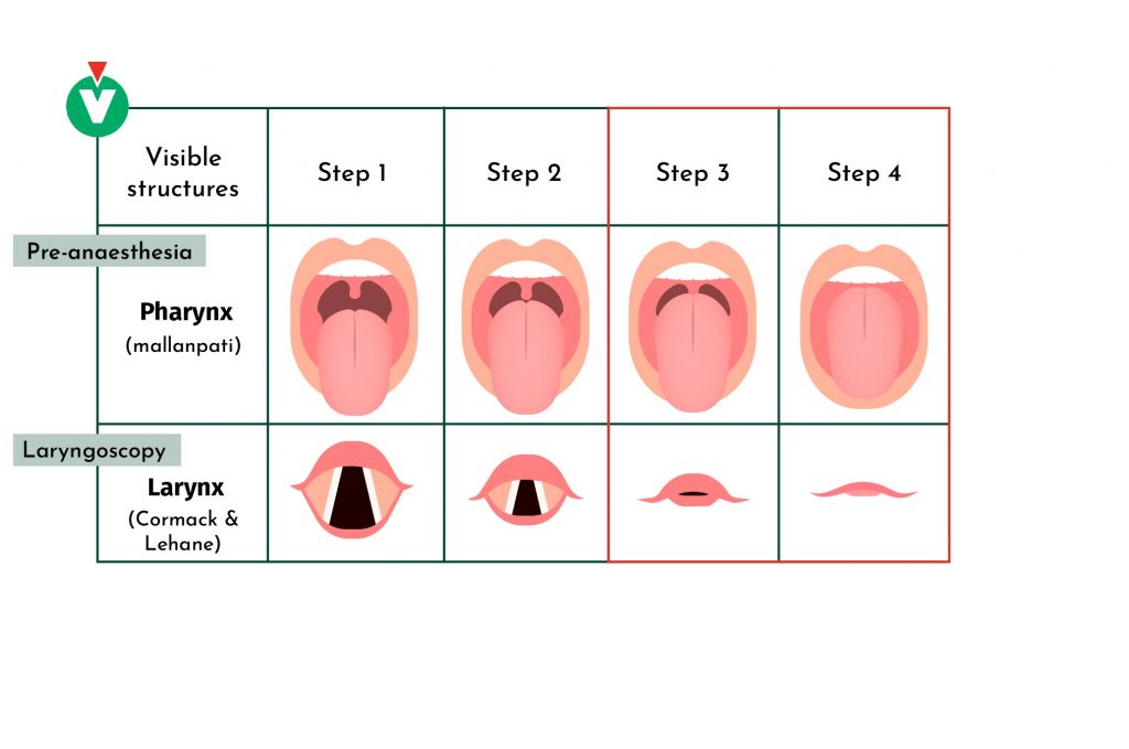 Mallanpati, Cormack and Lehane pharyngeal and laryngeal scales
