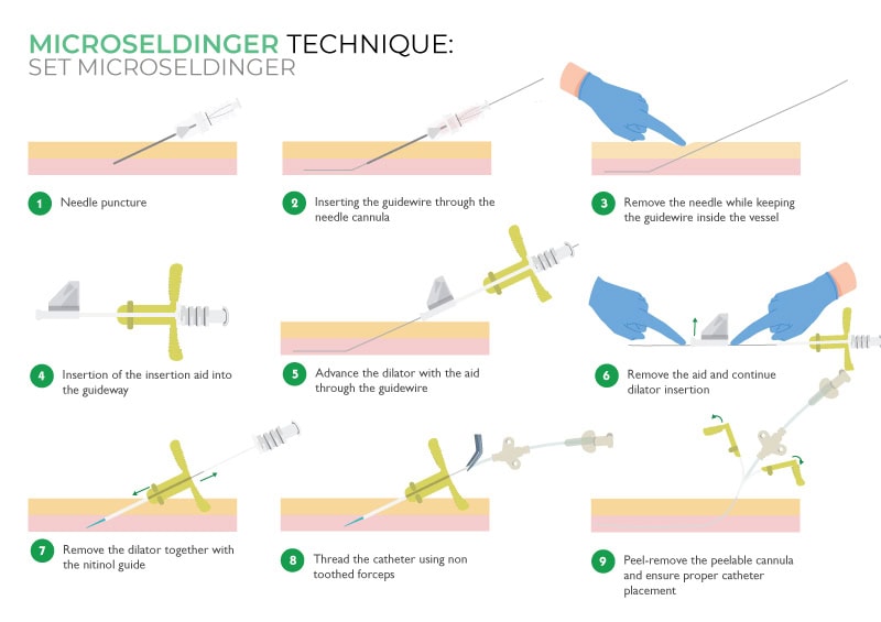 Microseldinger technique