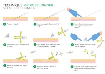 Technique microseldinger : set microseldinger