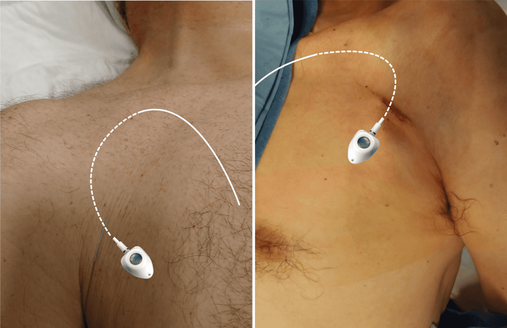 Right and left side subclavian puncture