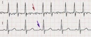 Plusieurs-ondes-P-chez-patients-atteints-fibrillation-auriculaire