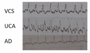 Pose-PICC-patients-atteints-fibrillation-auriculaire