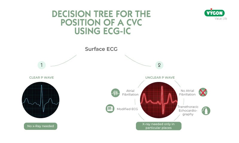 Decision-tree-for-the-position-of-a-central-venous-access-using-ECG