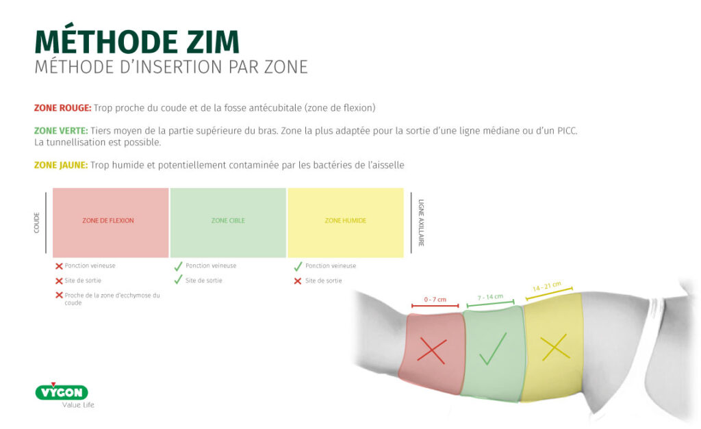 Schéma pédagogique de la méthode ZIM (Zone d’Insertion par Zone) pour l’insertion et la sortie d’un cathéter midline ou PICC, illustrant les zones du bras : zone rouge près du coude à éviter, zone jaune axillaire humide à risque infectieux et zone verte correspondant au tiers moyen du bras, zone cible recommandée pour la sortie du cathéter et la tunnellisation, afin de réduire les complications et améliorer la sécurité de l’accès vasculaire.