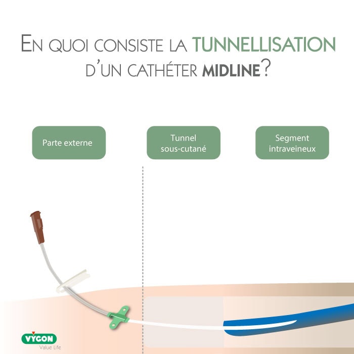 Schéma explicatif de la tunnellisation d’un cathéter midline, montrant la partie externe du dispositif, le tunnel sous-cutané et le segment intraveineux. L’illustration détaille le trajet du cathéter sous la peau avant l’insertion veineuse, afin d’améliorer la stabilité du dispositif et de réduire le risque de complications.