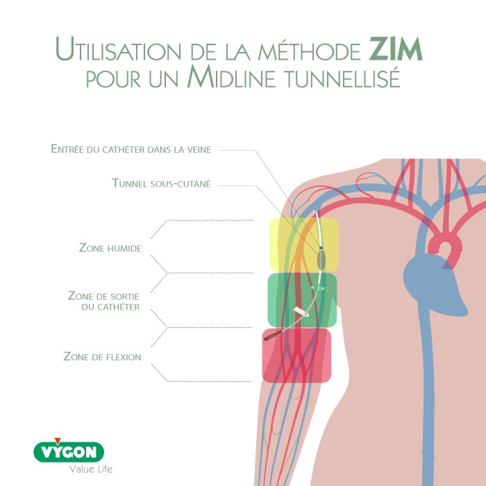Schéma explicatif de la tunnellisation d’un cathéter midline utilisant la méthode ZIM, identifiant la zone humide, la zone de sortie du cathéter, la zone de flexion, l’entrée du cathéter dans la veine et le tunnel sous-cutané. L’illustration met en évidence le trajet sécurisé du cathéter afin de réduire le risque d’infection et d’améliorer la fixation et la durabilité de l’accès vasculaire.