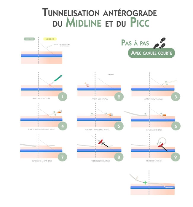 Schéma pas à pas de la tunnellisation antérograde et rétrograde d’un cathéter midline ou PICC, illustrant les différentes étapes de la procédure : incision au bistouri, anesthésie locale, ponction veineuse, création du tunnel sous-cutané, insertion du guide, de l’introducteur puis du cathéter, avec repérage des zones jaune et verte pour une insertion sécurisée et une réduction des complications.