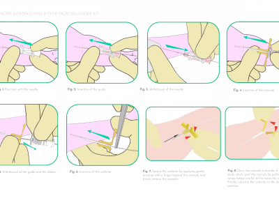 Catheter introduction with a Microseldinger kit