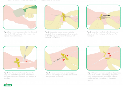 Catheter introduction with a peelable cannula