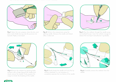 Catheter introduction with a splitting needle