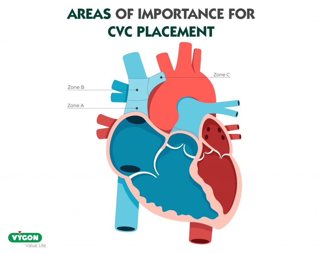 area-placement-cvc