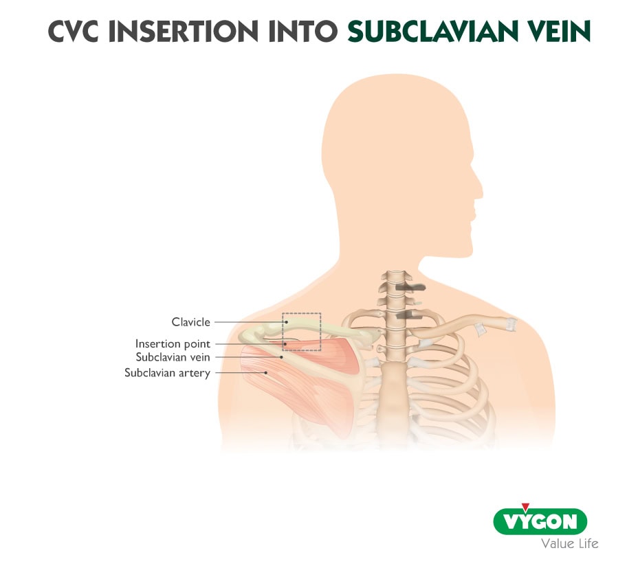 insertion-cvc-subclavian-vein