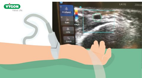 Ultrasound-guided arterial cannulation in 6 steps - Campus Vygon Global