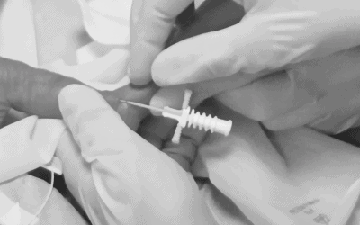 Cost Analysis of the Modified Seldinger Technique (MST) for neonatal PICC Insertion