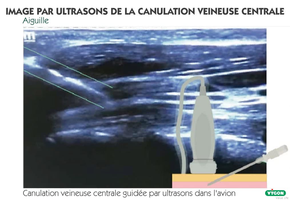 Image échographique de la canulation veineuse centrale guidée par ultrasons, montrant l’aiguille visualisée dans le plan lors de la ponction veineuse. Le schéma met en évidence le positionnement précis de l’aiguille sous contrôle échographique afin de sécuriser l’accès veineux central et de réduire le risque de complications mécaniques.