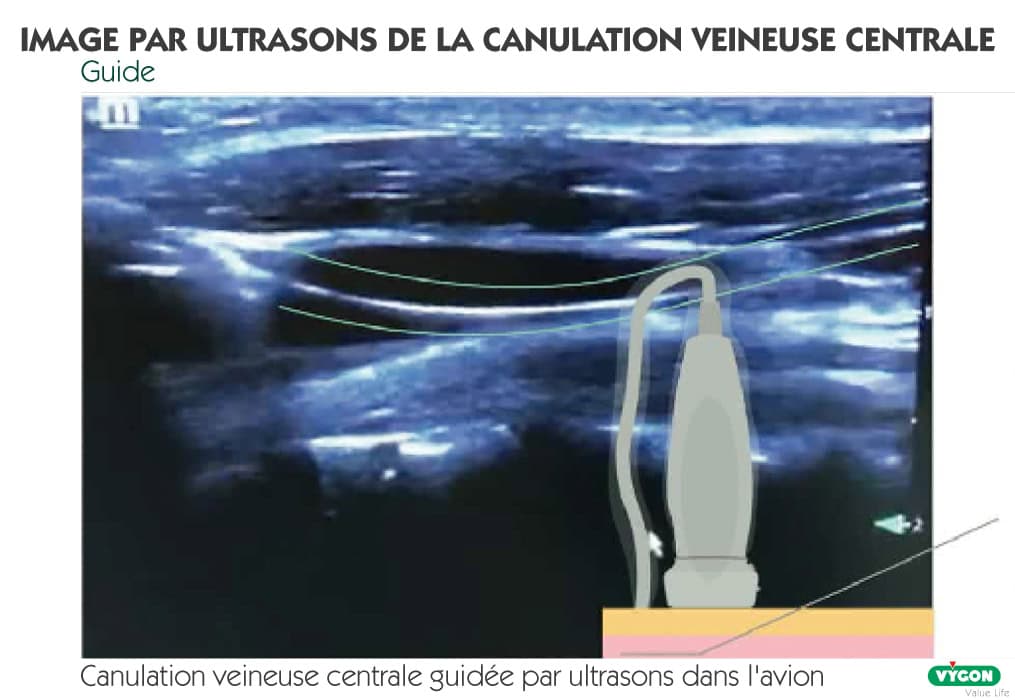 Échographie médicale illustrant les étapes de la canulation veineuse centrale guidée par ultrasons avec visualisation de l’aiguille, du guide et du cathéter dans la veine, utilisée pour améliorer la précision et réduire les complications d’un accès veineux central.