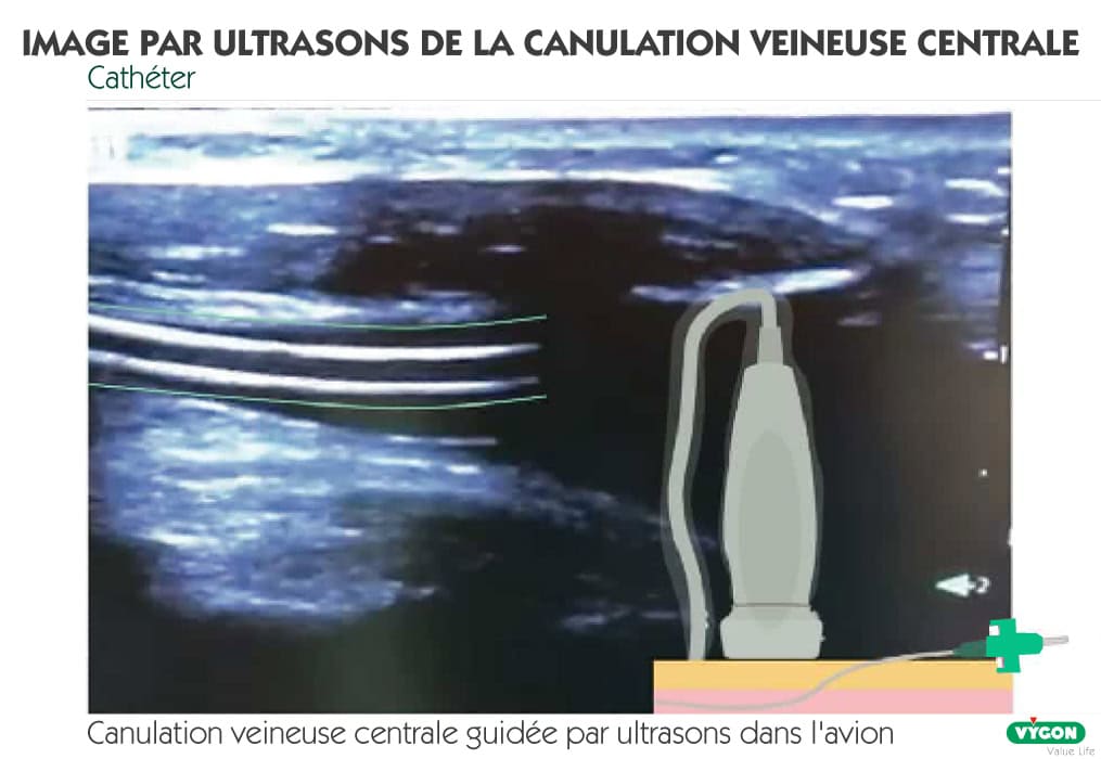 Image échographique de canulation veineuse centrale guidée par ultrasons montrant le cathéter inséré dans une veine, avec visualisation en temps réel des structures anatomiques pour un accès vasculaire central sécurisé.