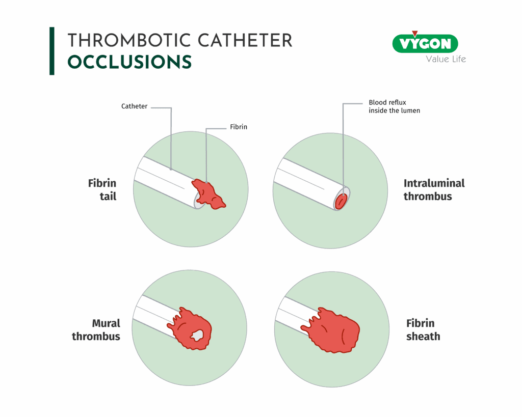 Thrombotic catheter occlusion