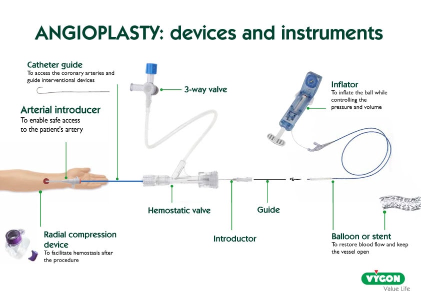 Diagram of angioplasty devices and instruments including catheter guide, arterial introducer, radial compression device, 3-way valve, hemostatic valve, introducer, guide, inflator, and balloon or stent, used to access arteries, control pressure, and restore blood flow during the procedure.