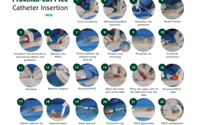 Proximal-Cut PICC Catheter Insertion