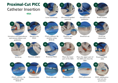 Proximal-Cut PICC Catheter Insertion