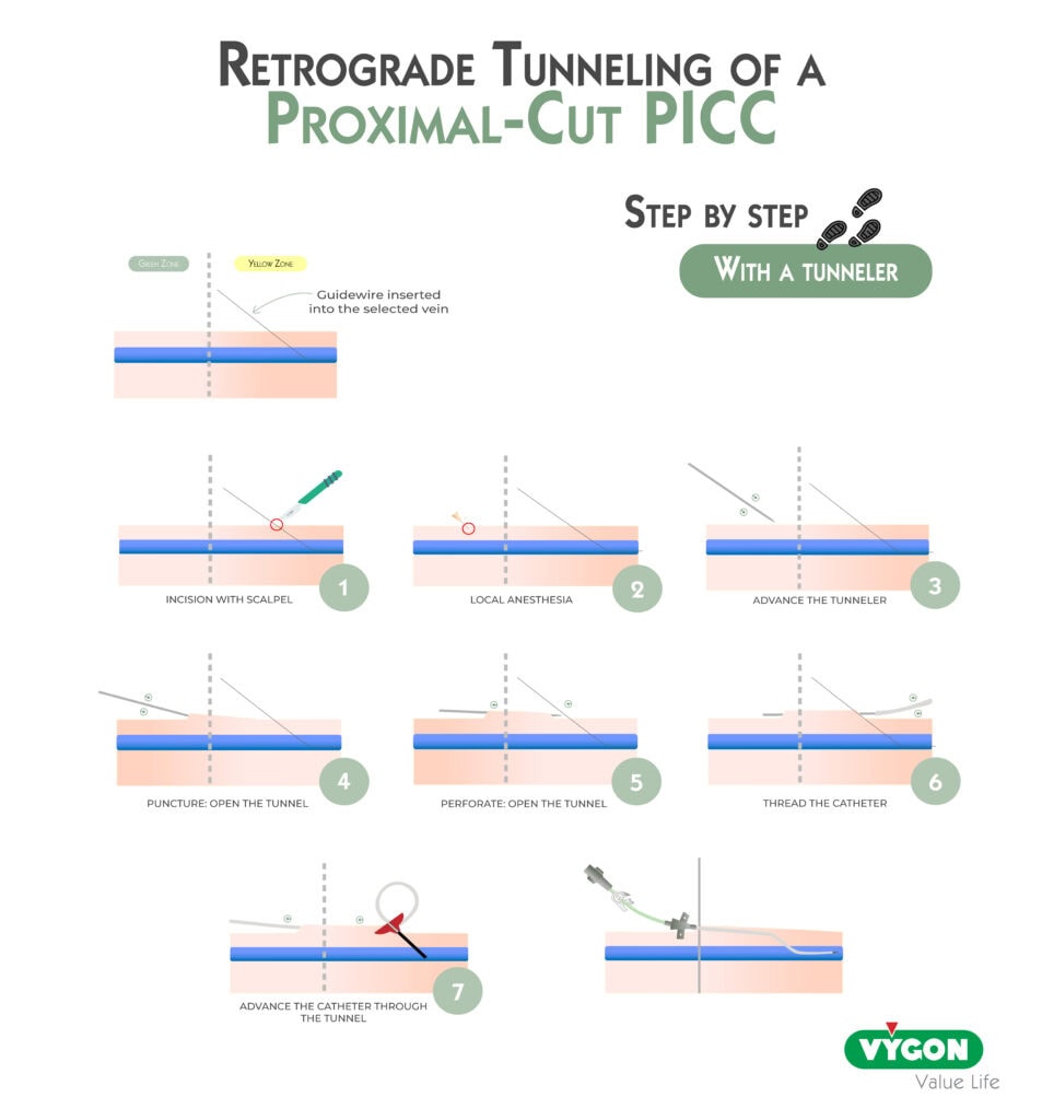 Retrograde-Tunneling-of-a-Proximal-Cut-PICC