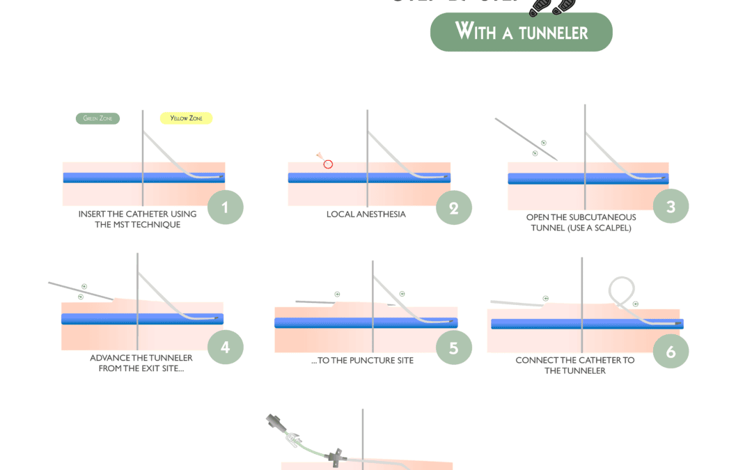 Retrograde Tunneling of a Proximal-Cut PICC