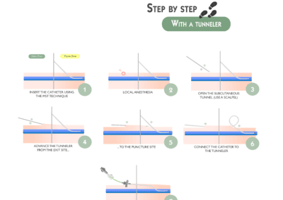 Retrograde Tunneling of a Proximal-Cut PICC